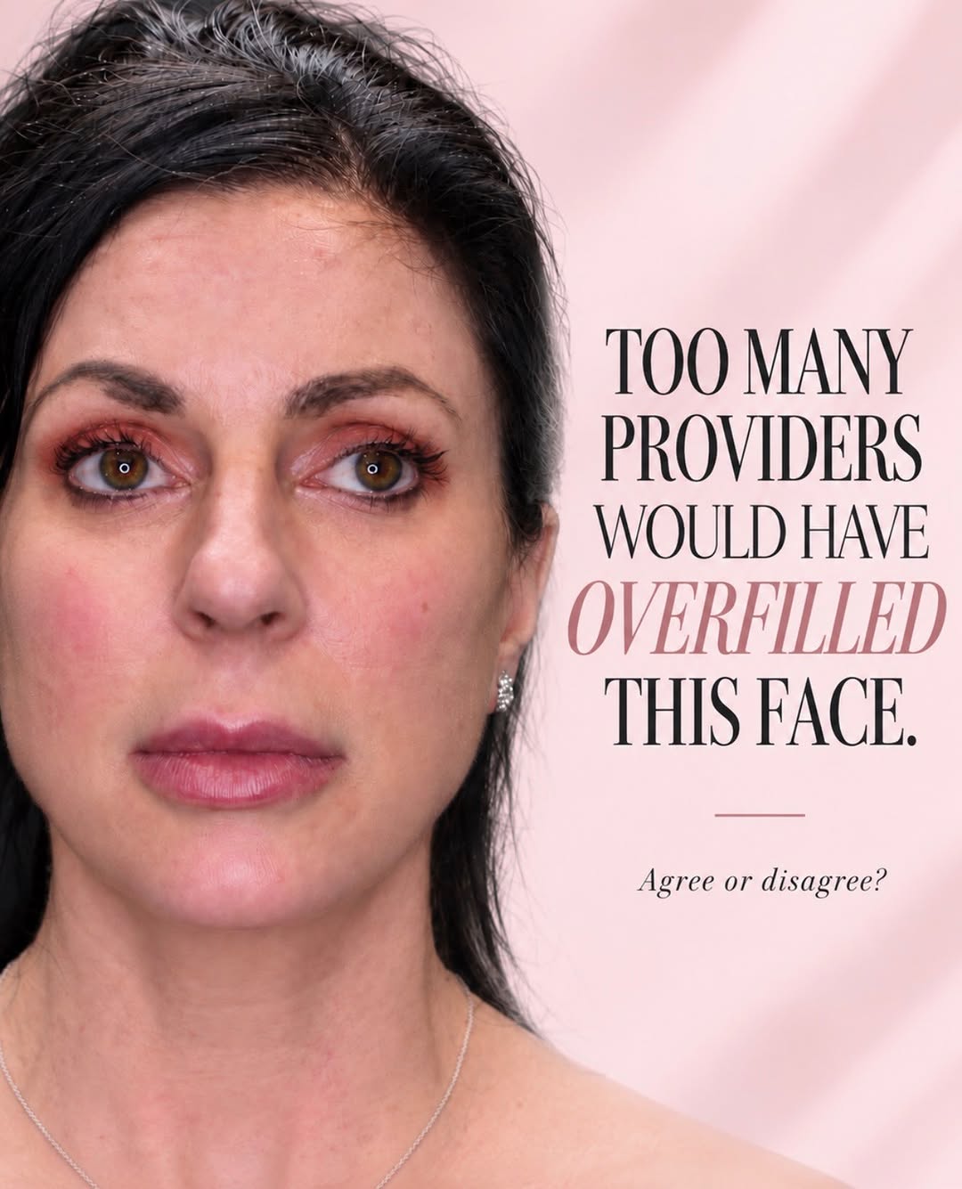 Instagram post by Dr. Georges Kaado: What actually creates a natural-looking full-face result? Usually, it’s not one syringe, one area, or one treatment. In this case, we treate…