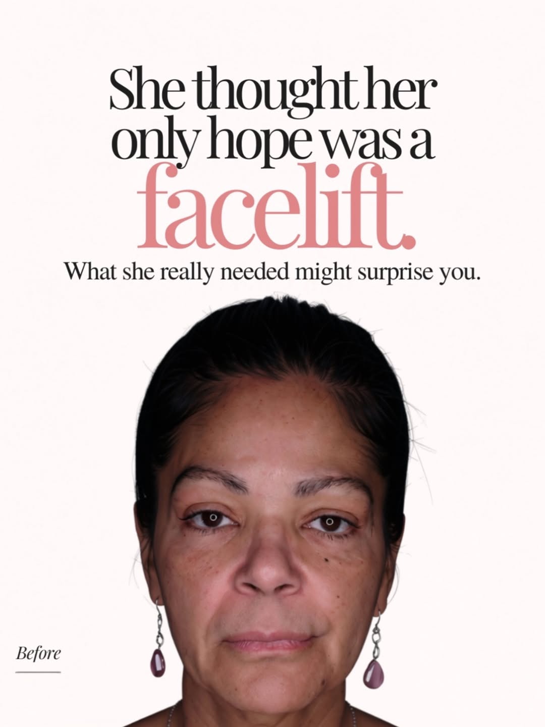 Instagram post by Dr. Georges Kaado: Many patients come to me thinking their only option is surgery. But in many cases, that is not the first step. When I evaluated her face, I …