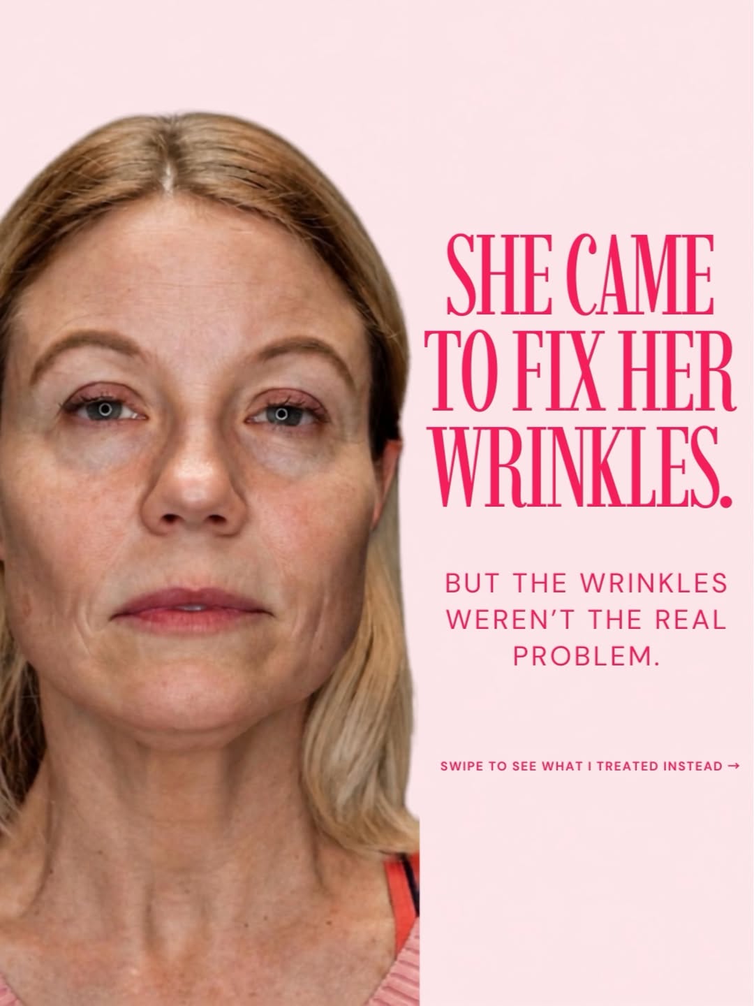 Instagram post by Dr. Georges Kaado: She came in asking me to treat her wrinkles. But the wrinkles were not the whole problem. What I saw was a combination of targeted volume lo…