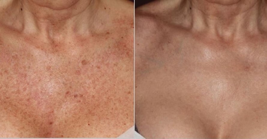 Instagram post by Dr. Gergana Gallacher: Chest rejuvenation results ✨ These before-and-after show how laser treatments can help improve sun damage, uneven tone, redness, and crepey …