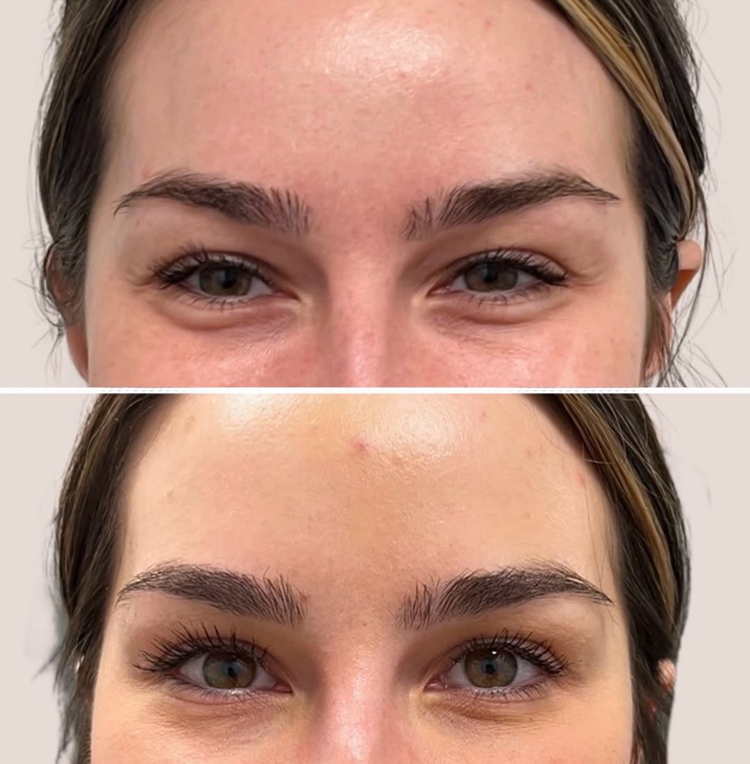 Instagram post by Dr. Gergana Gallacher: A subtle change can make a big difference. ✨ This treatment targeted the under-eye jelly roll with a precise amount of Dysport to soften the…