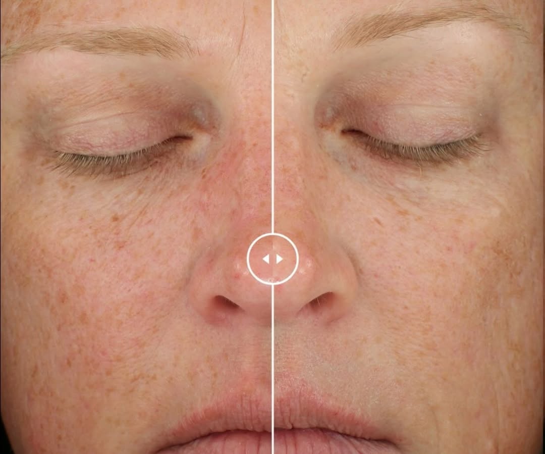 Instagram post by Dr. Gergana Gallacher: ✨ DiamondGlow Results That Speak for Themselves ✨ These before & after shows how DiamondGlow can leave your skin looking smoother, brighter,…