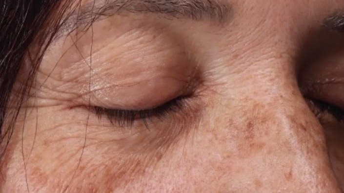Instagram post by Dr. Gergana Gallacher: Fraxel FTX ✨ Swipe to see the results → Reveal smoother, brighter, more youthful-looking skin with Fraxel FTX. This advanced laser treatment…