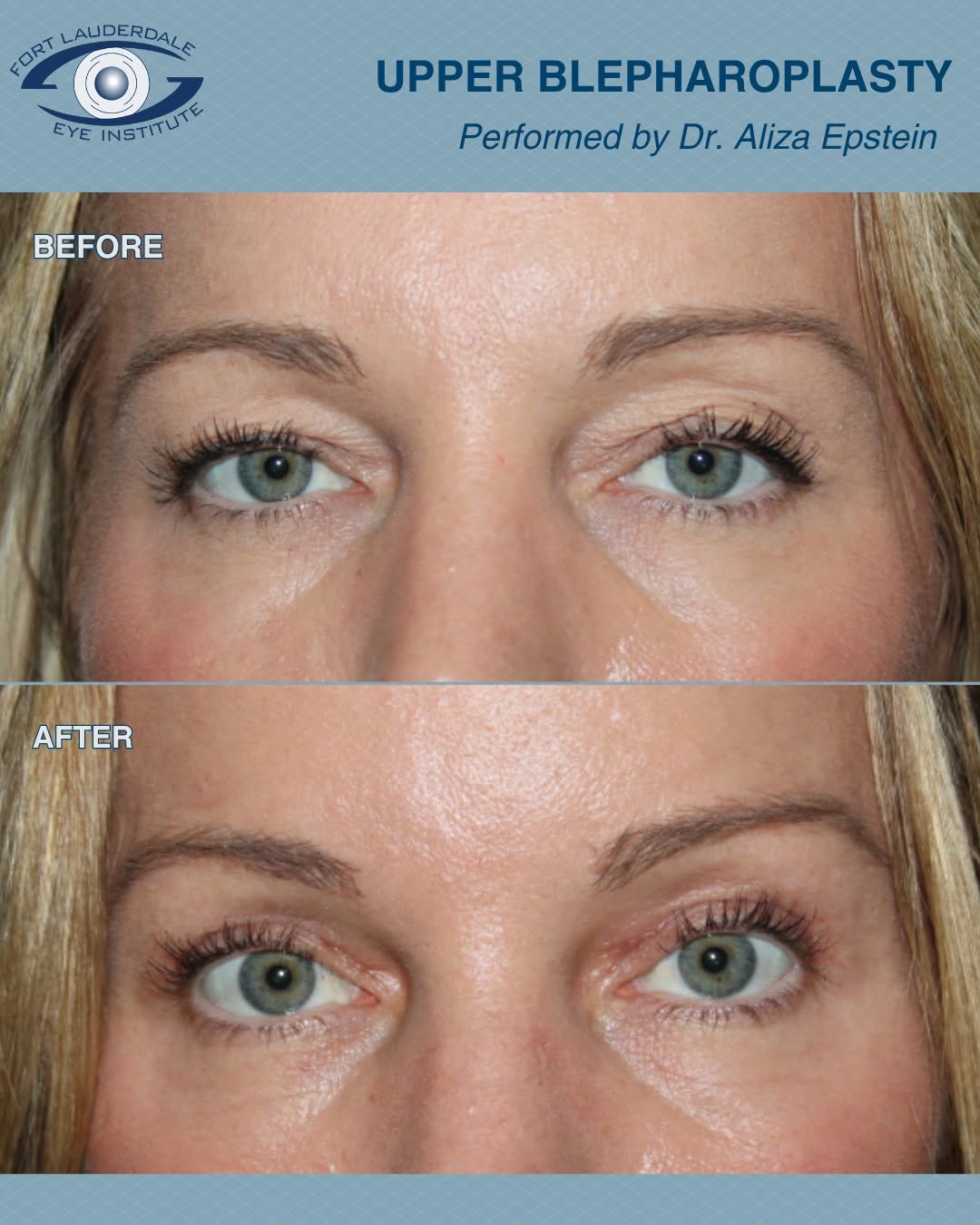 Instagram post by Dr. Gil A. Epstein: This patient achieved a beautiful, refreshed, and natural appearance following upper blepharoplasty, and this photo was taken just 3 weeks a…