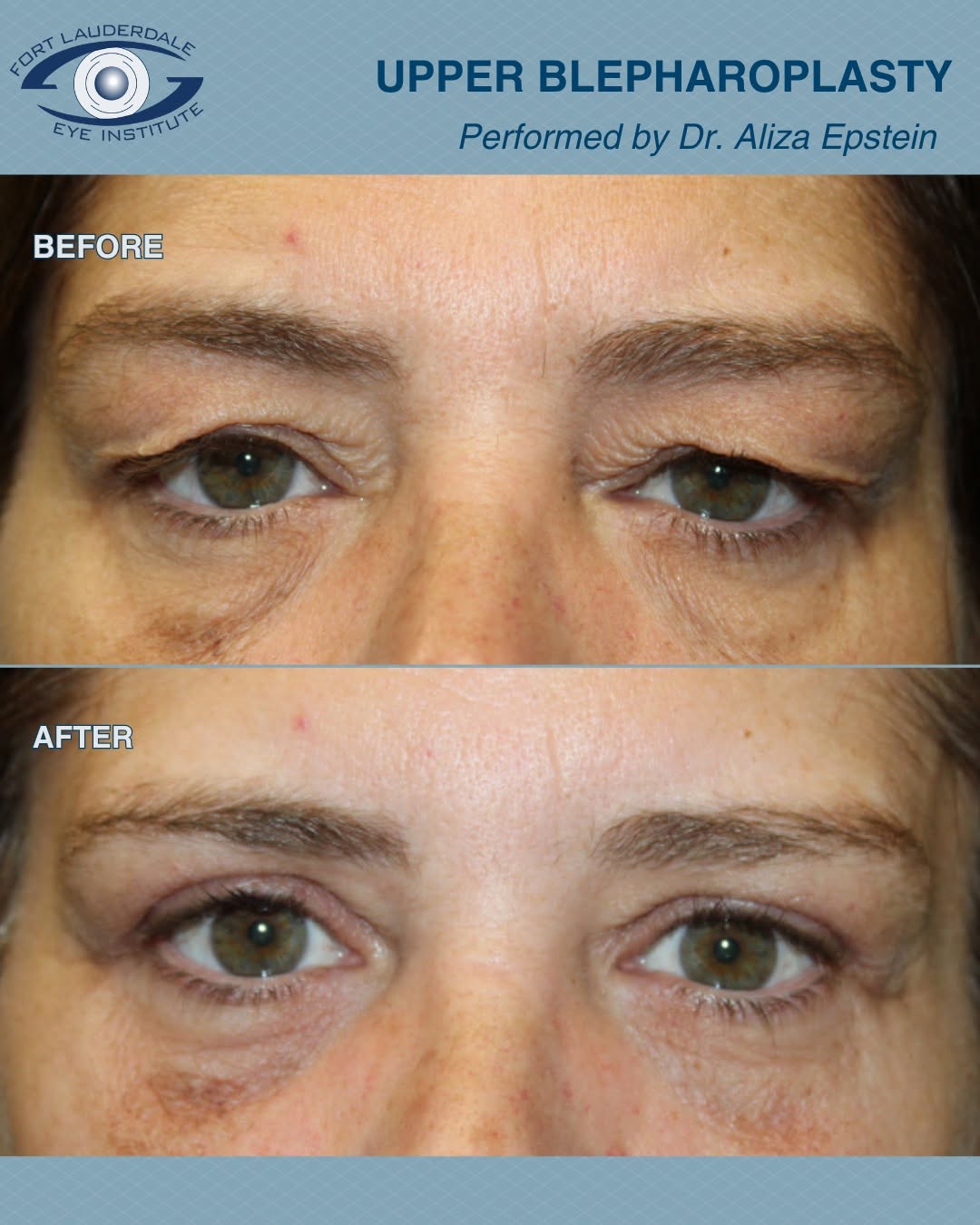 Instagram post by Dr. Gil A. Epstein: Upper blepharoplasty addresses excess skin and tissue of the upper eyelids, creating a more open and refreshed appearance while preserving n…