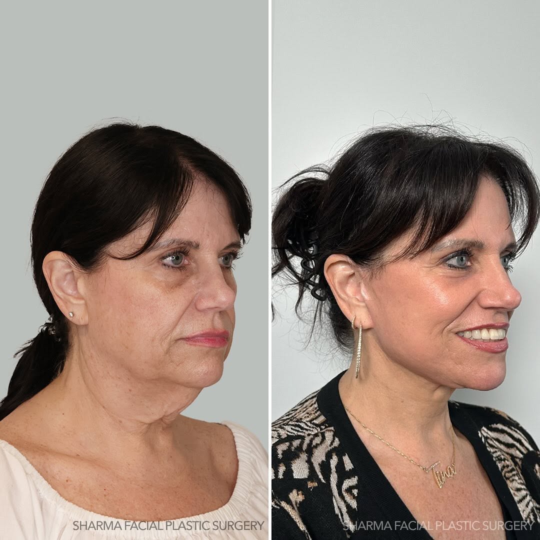 Instagram post by Dr. Giriraj K. Sharma: Full-face rejuvenation, 9 month update! 60 is the new 40 😉 Our patient underwent our #sharmasignature full-face surgical rejuvenation and C…