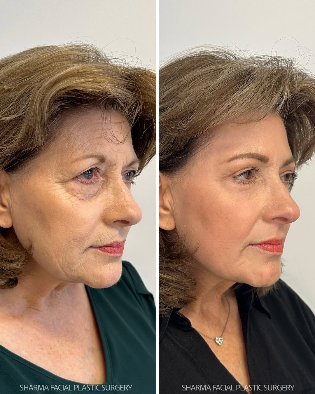 Instagram post by Dr. Giriraj K. Sharma: Upper facial rejuvenation + CO2 laser ✅ Endoscopic brow lift ✅ Upper blepharoplasty ✅ Lower blepharoplasty ✅ Facial fat transfer: eyes, chee…