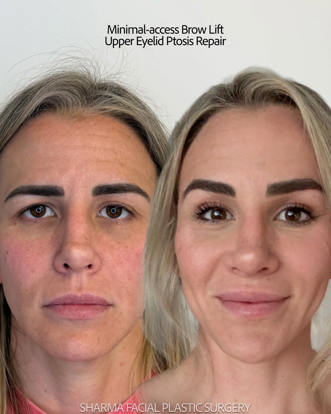 Instagram post by Dr. Giriraj K. Sharma: WOW. I can’t get over this glow up! ✅ Brow lift ✅ Upper blepharoplasty with Ptosis repair We still need to take my beautiful patient’s offic…