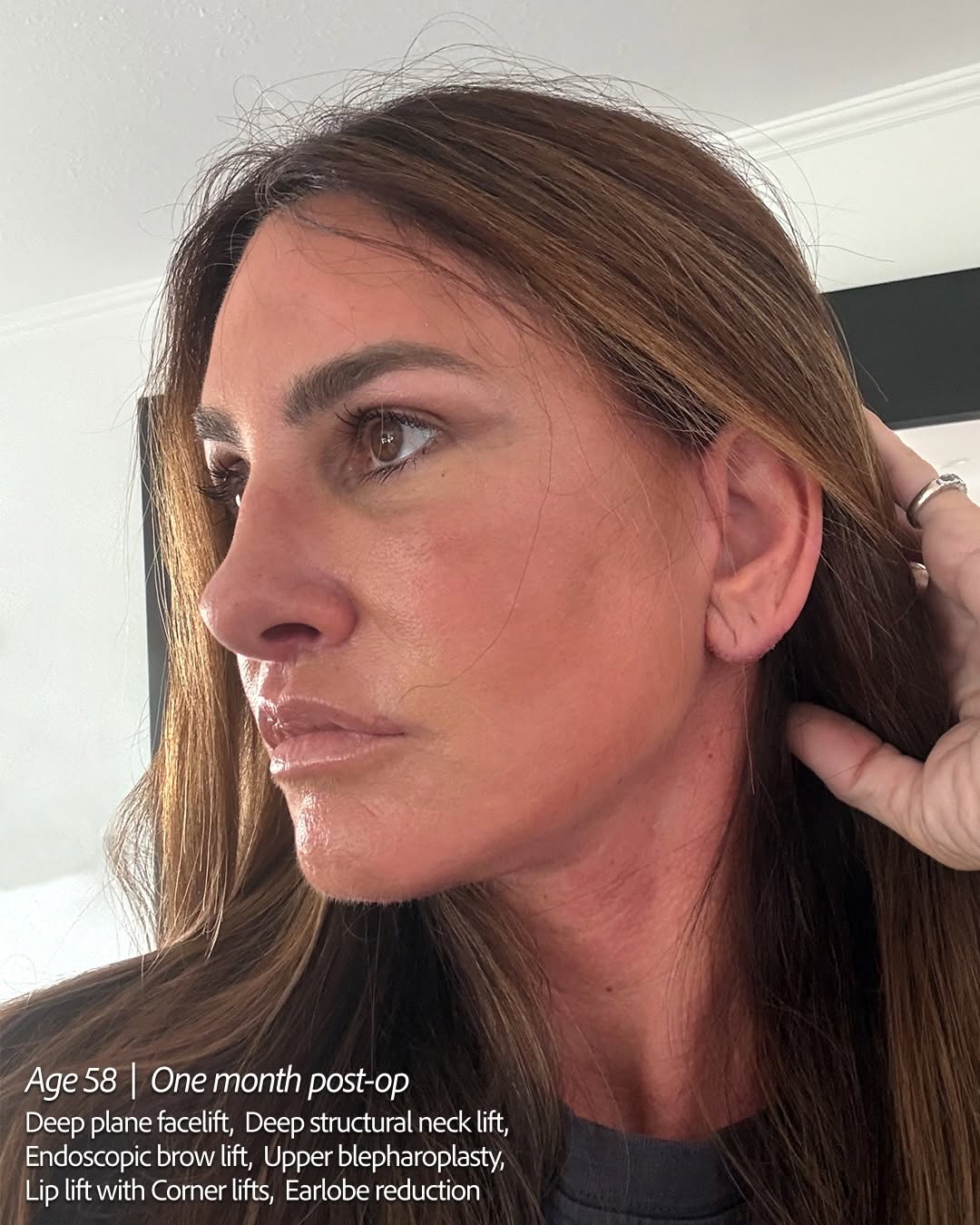 Instagram post by Dr. Giriraj K. Sharma: HOW is she 58?! Swipe ➡️ My stunning patient is 3.5 weeks post-op. She told me she went out with her girlfriends last night for the first ti…