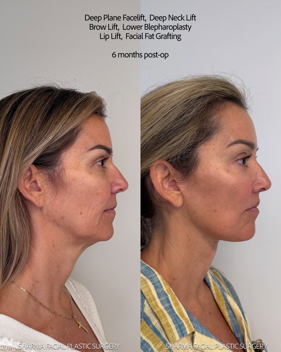 Instagram post by Dr. Giriraj K. Sharma: We LOVE how refreshed and natural she looks! My lovely patient (51) is 6.5 months post-op from full facial rejuvenation: ✅ Deep plane faceli…