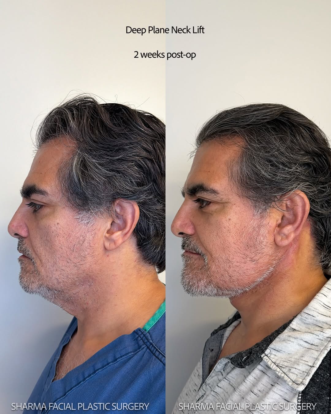 Instagram post by Dr. Giriraj K. Sharma: Deep Plane Neck Lift. Two (2) weeks post-op and we couldn’t resist a sneak preview of that jawline! I’m honored to call this gentleman a pat…
