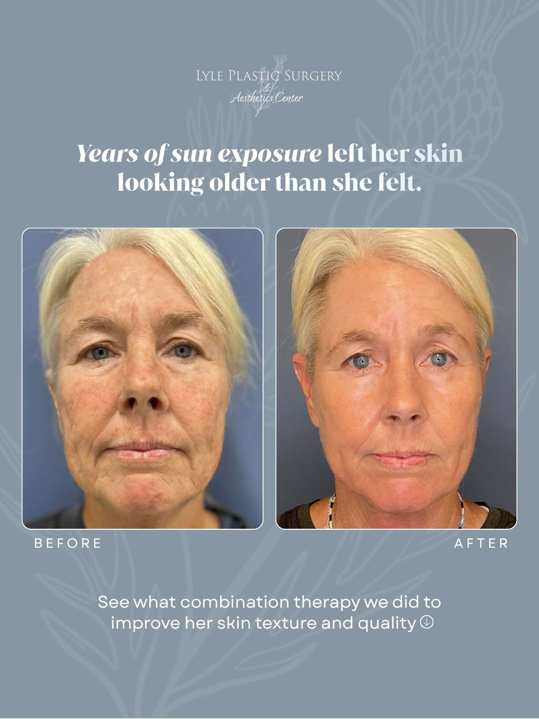 Instagram post by Dr. Glenn Lyle: We give each patient the personalized approach their skin needs. For this 60-year-old patient, years of sun exposure had left her with conce…