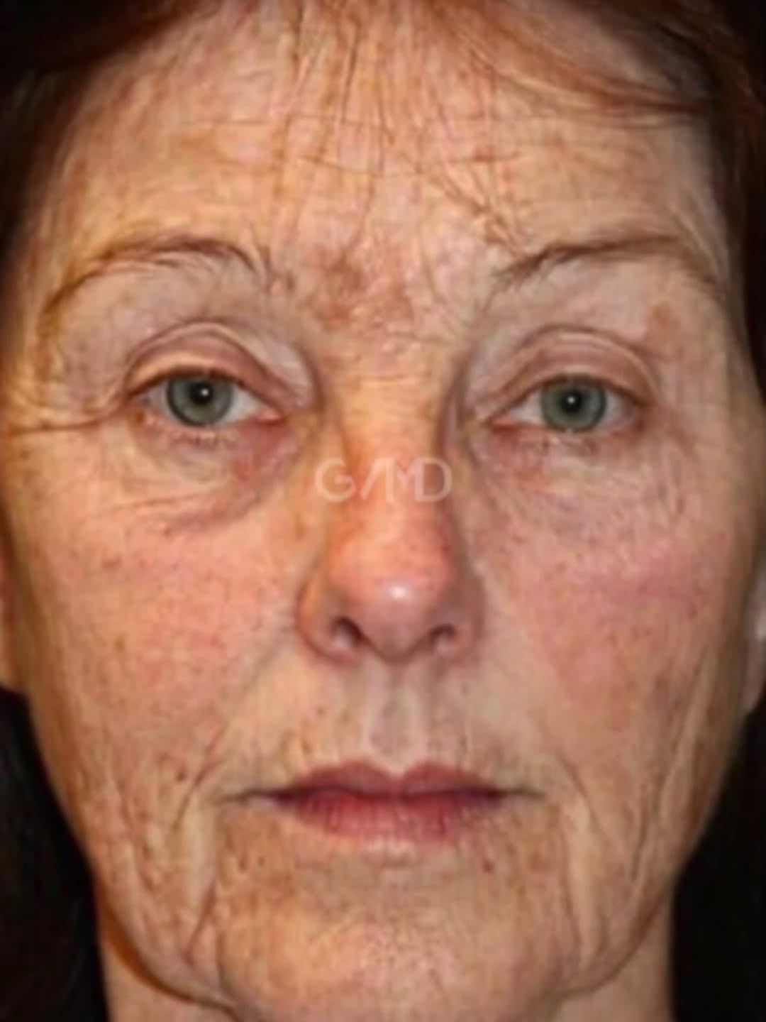 Instagram post by Dr. Glenn Vallecillos: ✨Rejuvenation Redefined! 💫 Explore this remarkable before and after journey of a patient who underwent a transformative GVMD Facelift and a…