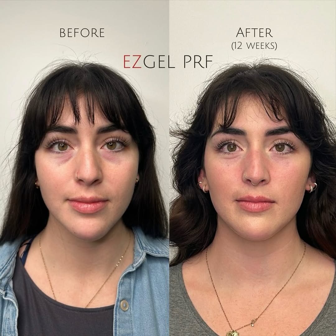 Instagram post by Dr. Gloria Duda: Can you believe this 12 week under eye transformation with EZGel PRF 😍💉 Our amazing patient j has had 2 sessions of PRF over the course of…