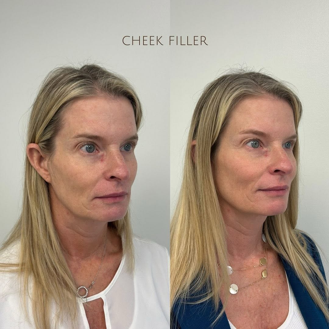 Instagram post by Dr. Gloria Duda: The POWER of cheek filler 🔥 This lovely patient came to us looking for a subtle yet impactful enhancement to give a more youthful appearanc…