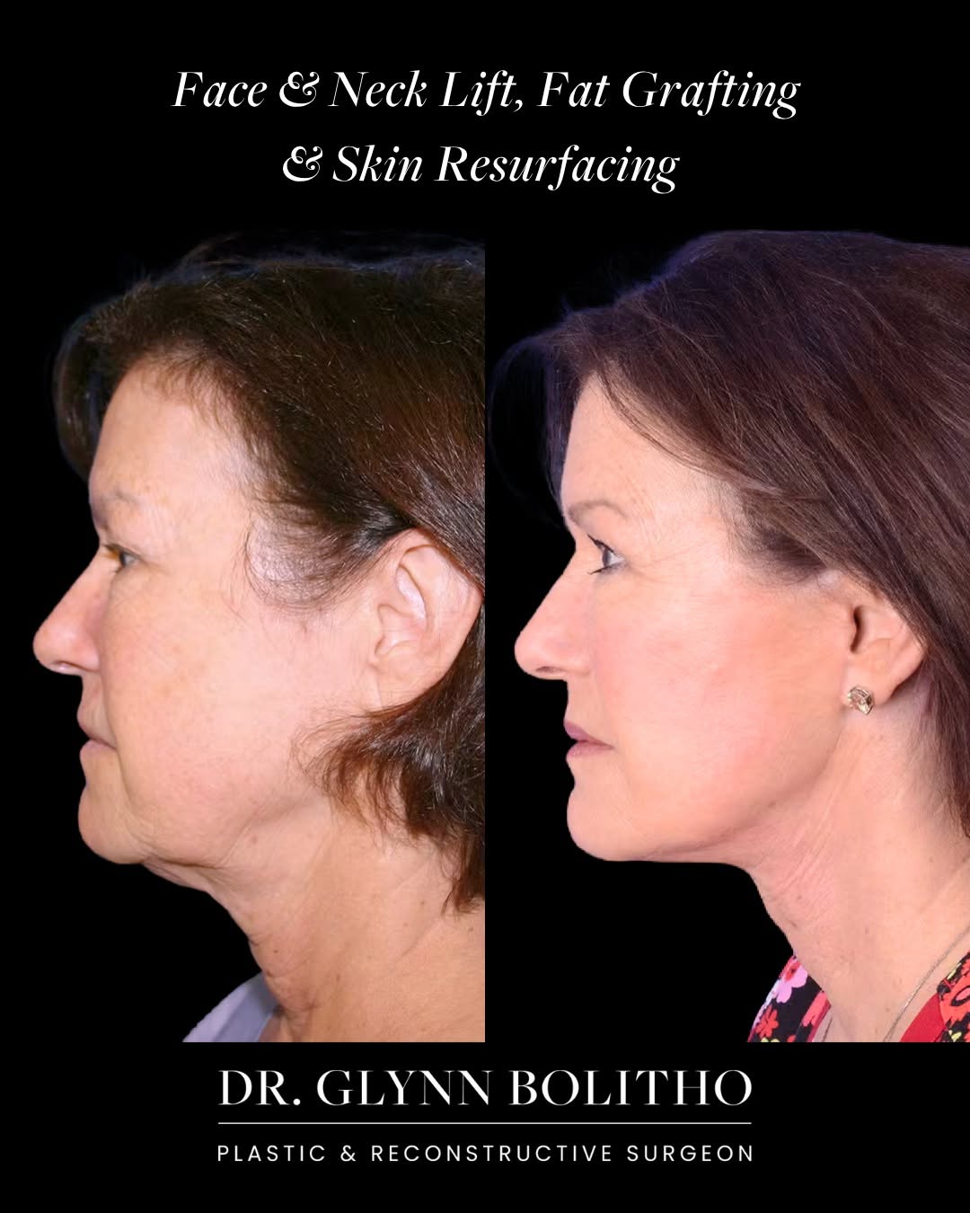 Instagram post by Dr. Glynn Bolitho, PhD: At 60, this patient wanted to look like a rested, refreshed version of herself, not someone new. We combined a deep plane face and neck lift…