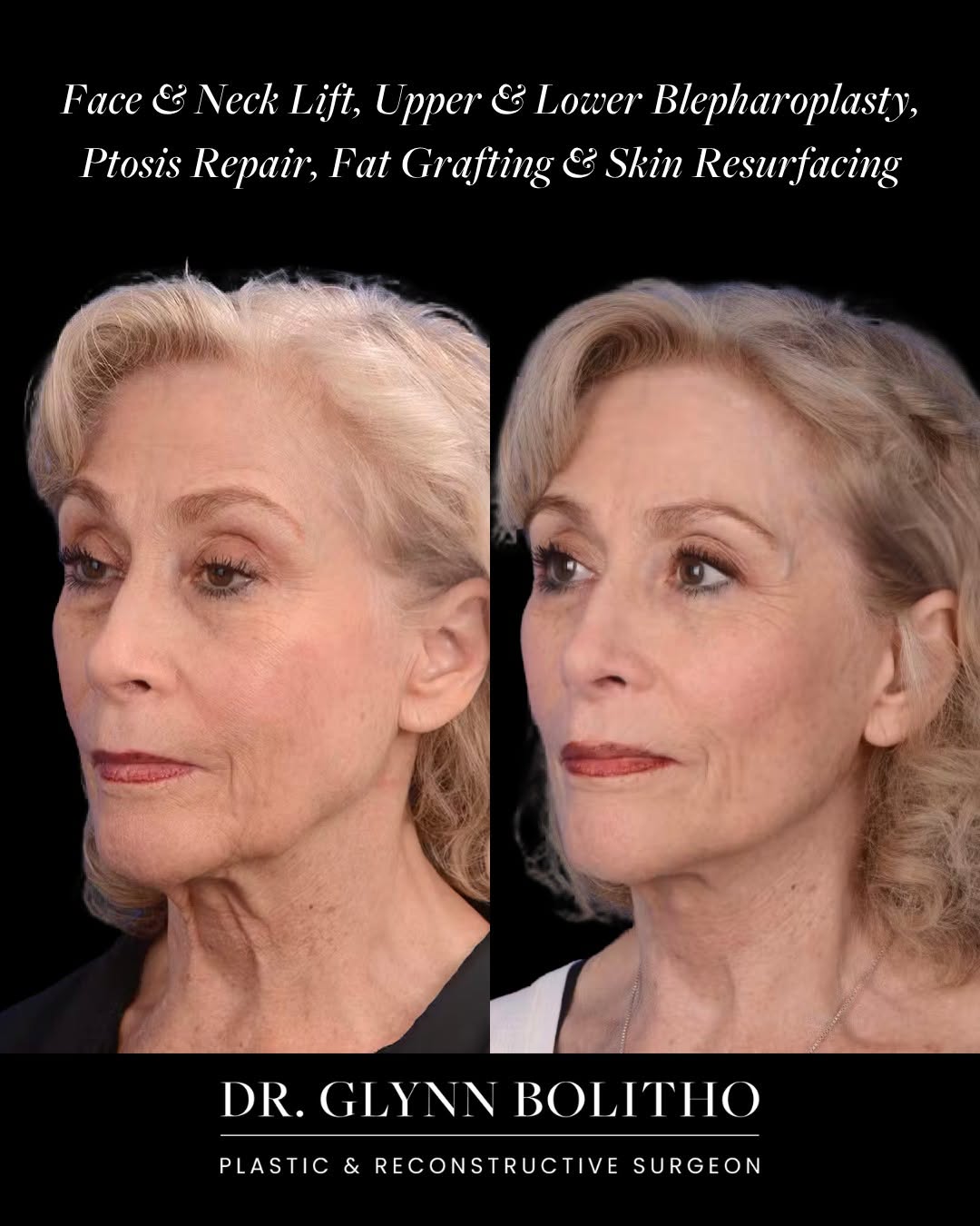Instagram post by Dr. Glynn Bolitho, PhD: This 69-year-old patient underwent a deep plane face and neck lift, fat grafting to the cheeks, upper and lower blepharoplasty, bilateral pt…