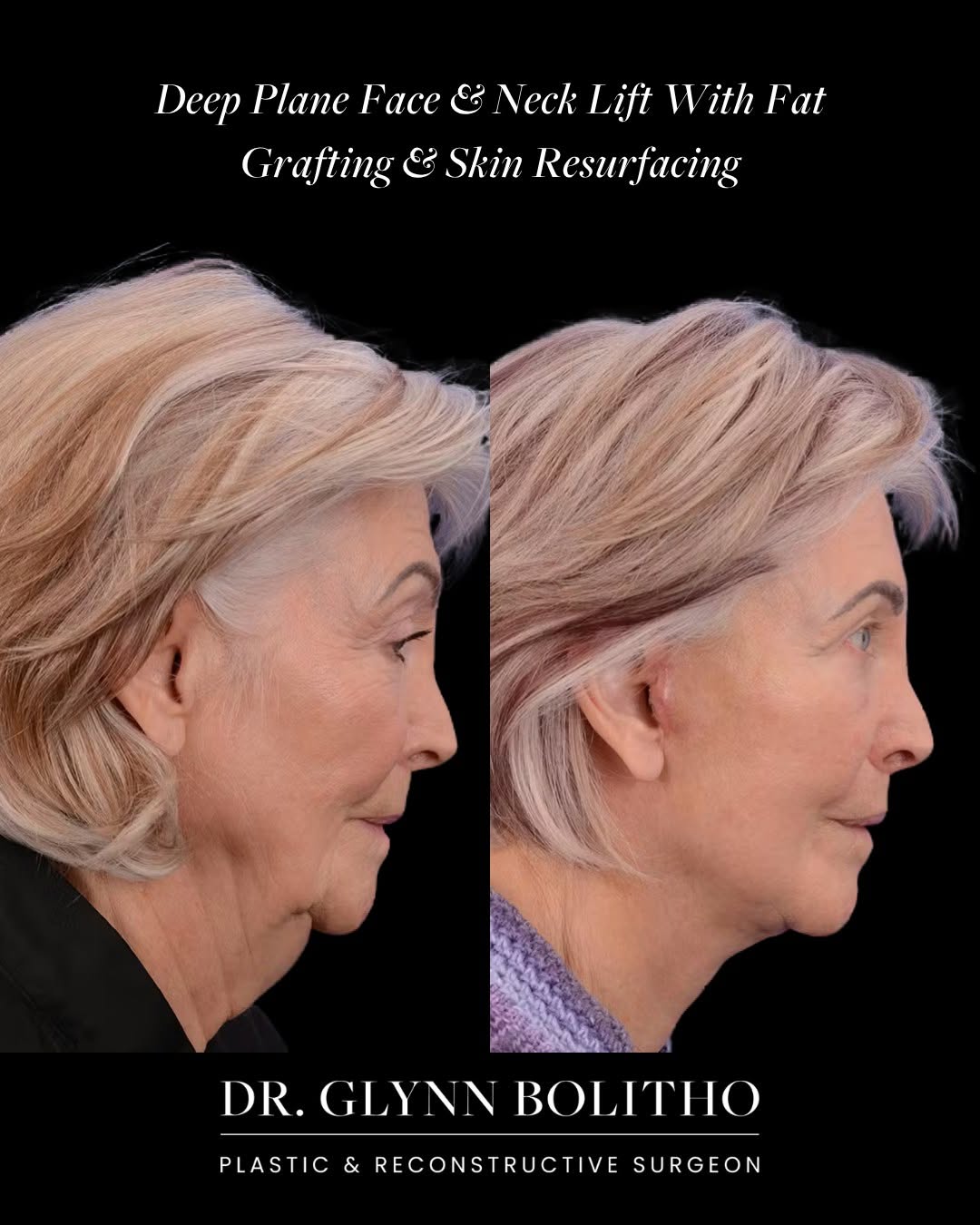 Instagram post by Dr. Glynn Bolitho, PhD: At 74, this patient's results are a testament to what comprehensive facial rejuvenation can truly achieve. This case combined a face and nec…