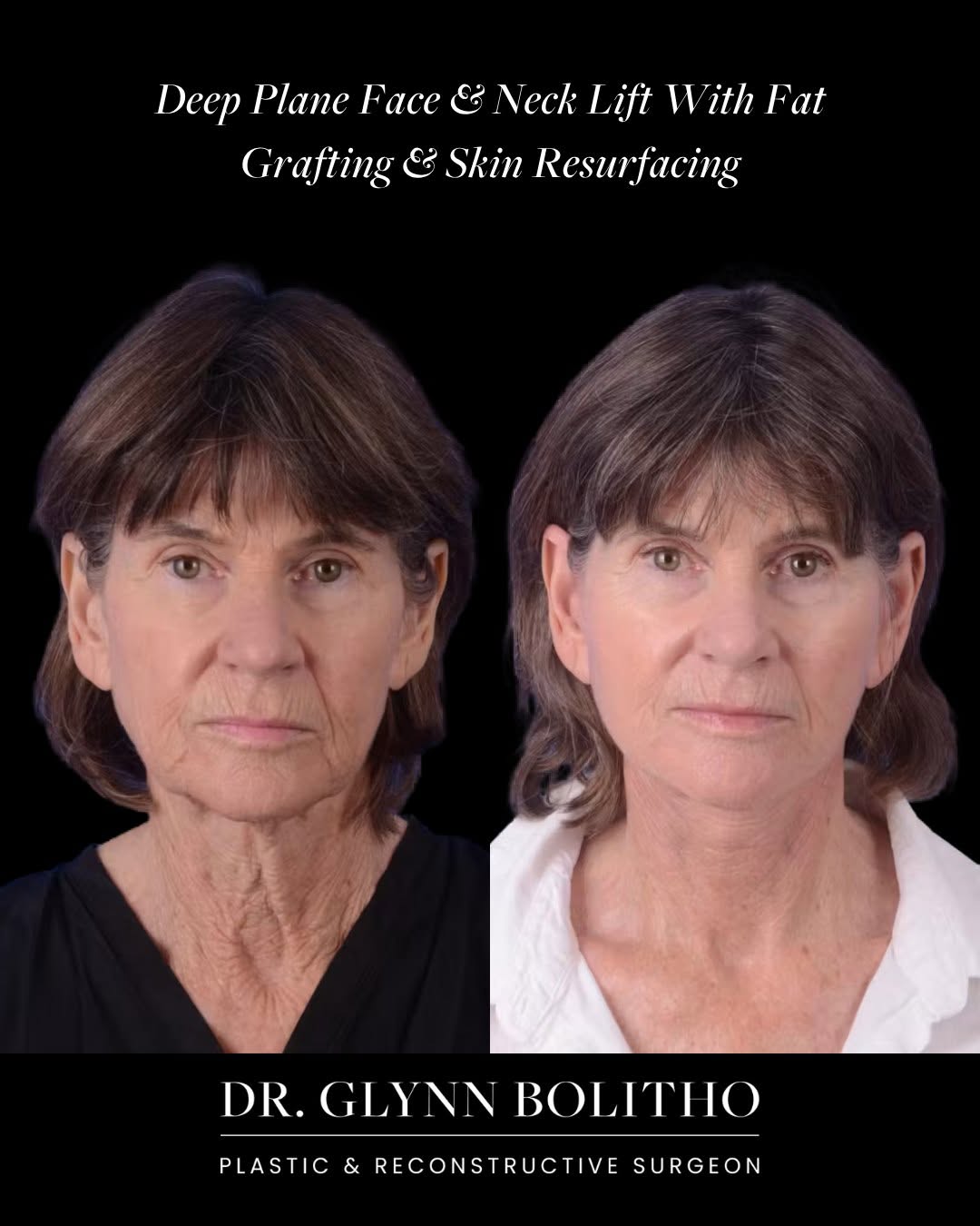 Instagram post by Dr. Glynn Bolitho, PhD: This is what happens when surgical precision meets artistic vision. For this 72-year-old patient, a face and neck lift was thoughtfully pair…