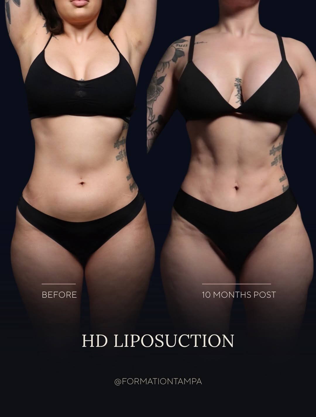 Instagram post by Dr. Gopal Grandhige: The abdomen can be one of the most stubborn areas to change, even with consistent diet and exercise. For this patient, HD liposuction addres…