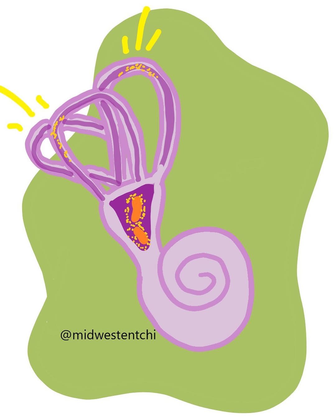 Instagram post by Dr. Gordon J. Siegel: Benign paroxysmal positional vertigo (BPPV) occurs when particles from your vestibular organ become trapped in your inner ear structures tha…