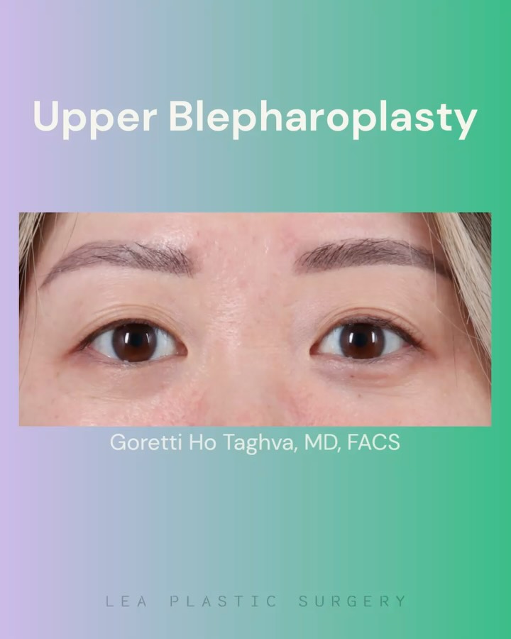 Instagram post by Dr. Goretti Ho Taghva: Sometimes the smallest changes make the biggest difference. ✨ This upper blepharoplasty was designed to even the eyelids, creating better sy…