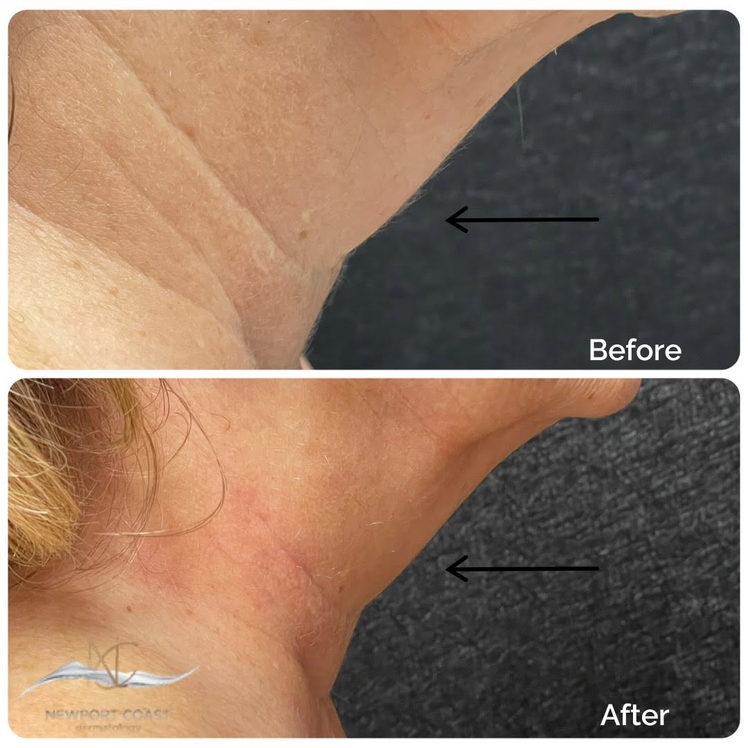 Instagram post by Dr. Grace Liu: ✨ XERF Neck Before + After ✨ A smoother, firmer-looking neck with improved definition without surgery or downtime 🤍 XERF uses monopolar rad…