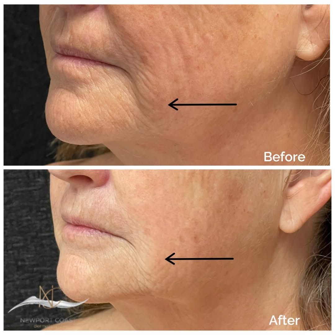 Instagram post by Dr. Grace Liu: Subtle tightening ✨ Noticeable difference 😍 This XERF before & after shows improvement in the lower face, with smoother-looking skin, softe…