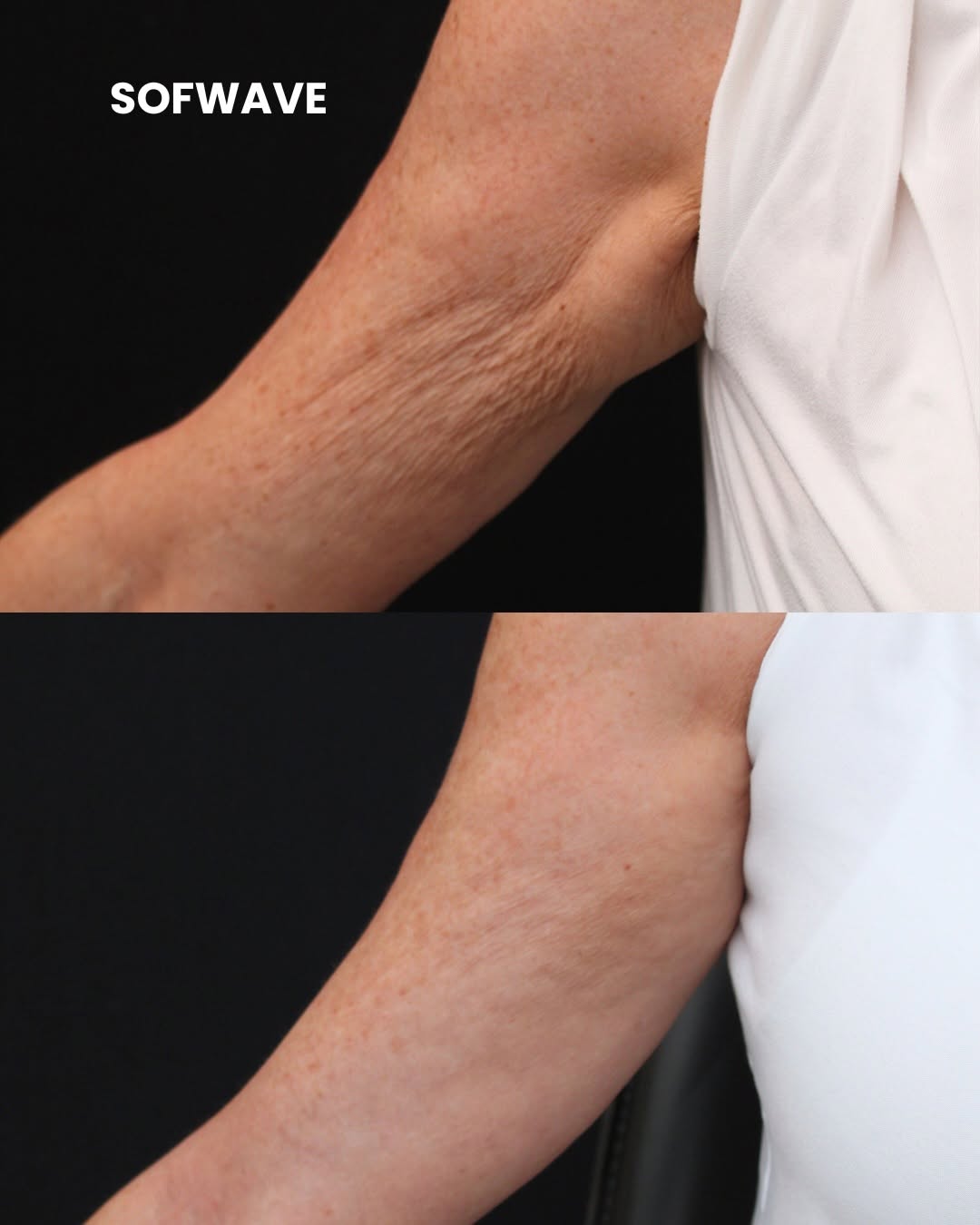 Instagram post by Dr. Greg Chernoff: Non-surgical skin tightening! 😱 Sofwave uses an ultrasound technology to send heat deep into the tissue to tightening and lift skin. No dow…