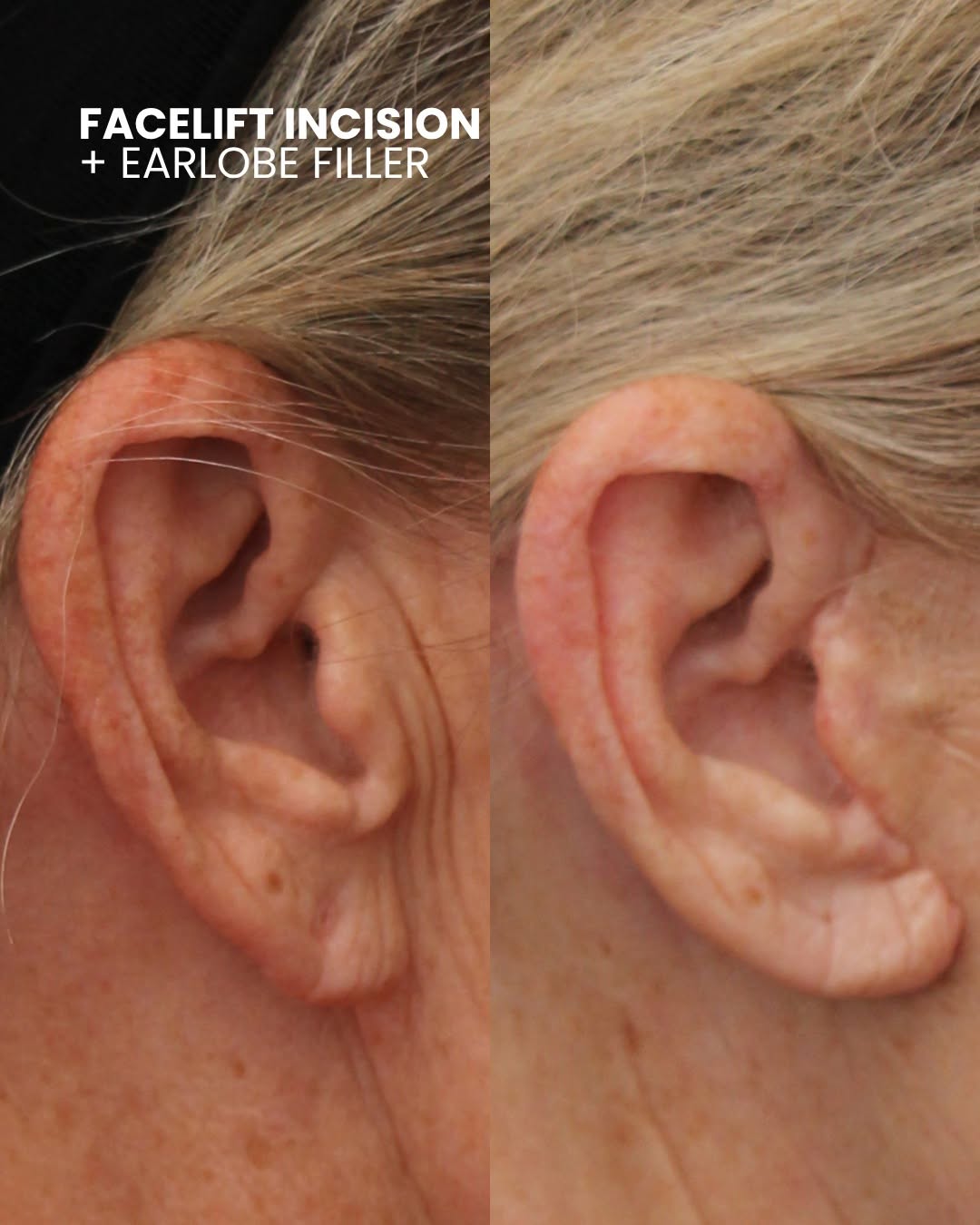Instagram post by Dr. Greg Chernoff: It’s all in the details. ✨ These two patients received a facelift with Dr. Chernoff, including careful attention to the earlobes for a more …