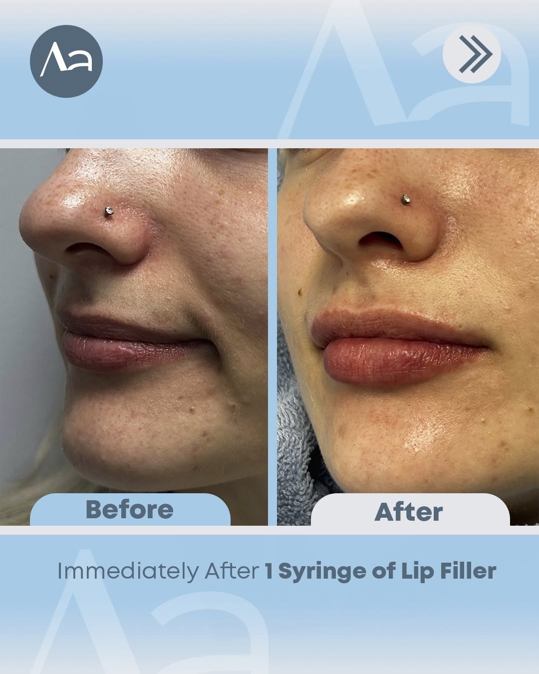 Instagram post by Dr. Gregory Alouf: Before and Immediately After Lip Filler by Dr. Greg👄 ☎️ Call (540) 375-9070 to schedule your appointment! 🥼 Dr. Gregory Alouf 💉 Lip Fille…