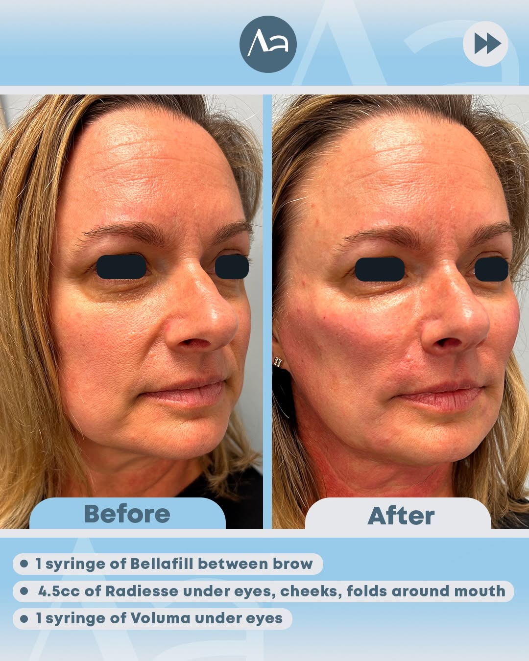 Instagram post by Dr. Gregory Alouf: This patient was treated with a customized combination of fillers to restore volume and support throughout the face: 💉 1 syringe of Bellafi…