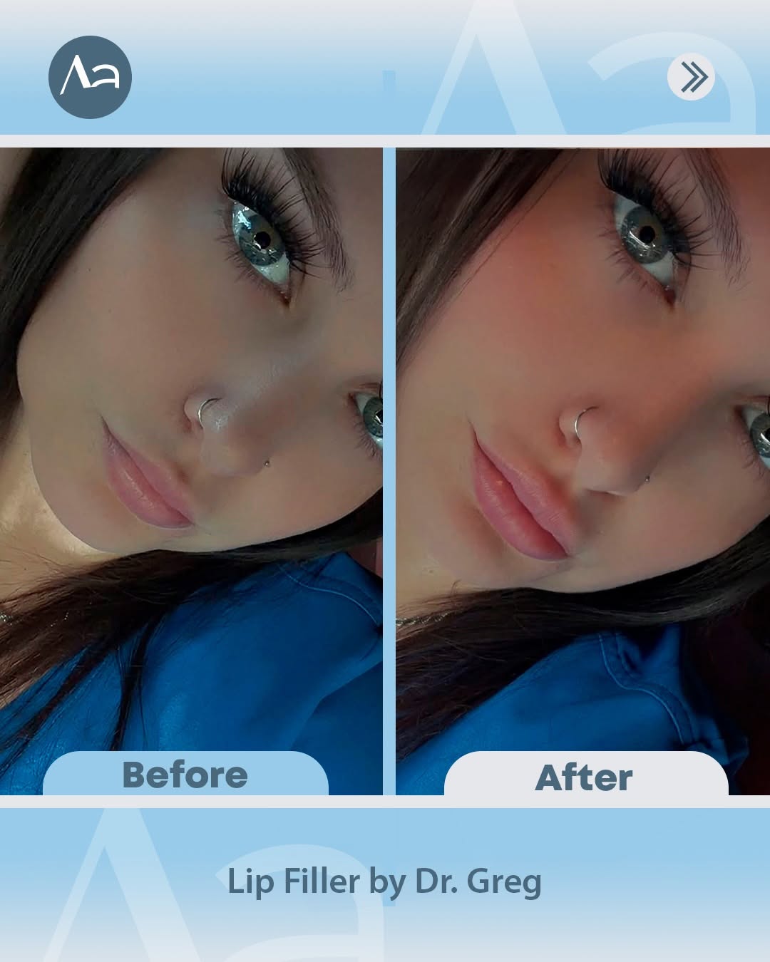Instagram post by Dr. Gregory Alouf: We LOVE patient selfies! 🤳 Before and After Lip Filler by Dr. Greg👄 ☎️ Call (540) 375-9070 to schedule your appointment! 🥼 Dr. Gregory Al…