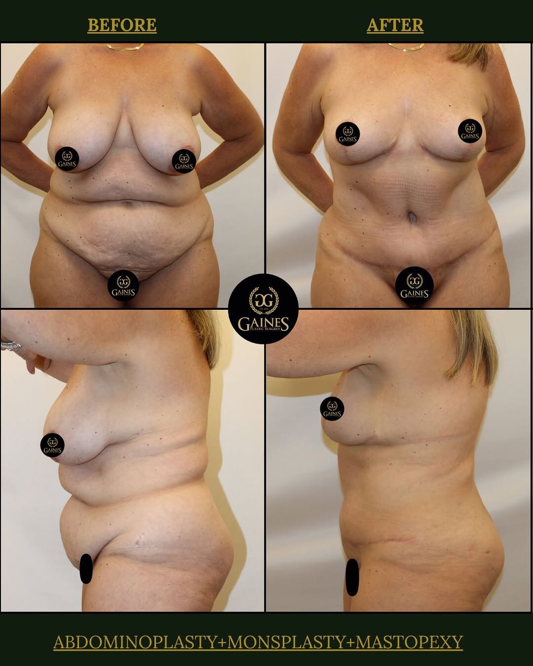 Instagram post by Dr. Gregory C. Gaines: A transformation you can see and a confidence you can feel✨ This stunning before and after shows the power of an Abdominoplasty. Restoring c…