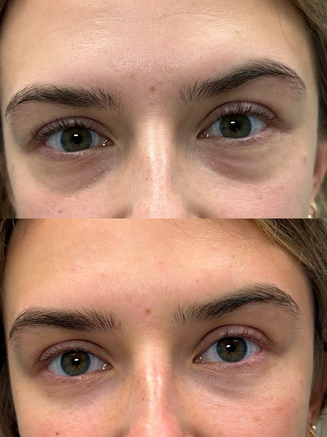 Instagram post by Dr. Gregory D. Lewen: Procedure: 1️⃣lower Blepharoplasty 2️⃣ fat grafting Patient presented with the chief complaint of, “I feel like I have very dark circles and…
