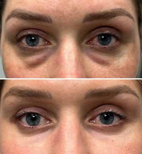 Instagram post by Dr. Gregory D. Lewen: Procedure: 1️⃣Lower Blepharoplasty 2️⃣ facial fat grafting 3️⃣ CO2 periorbital skin resurfacing 4️⃣ periorbital hyaluronidase ( dissolving o…