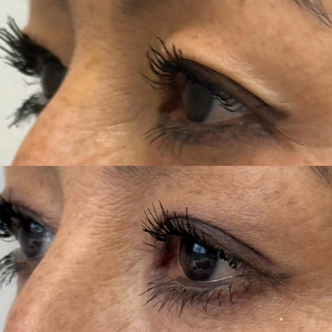 Instagram post by Dr. Gregory F. Bland: Your eyes are the first place time shows, and the hardest to treat. But not anymore! We are introducing a “baby bleph” using the UltraClear …