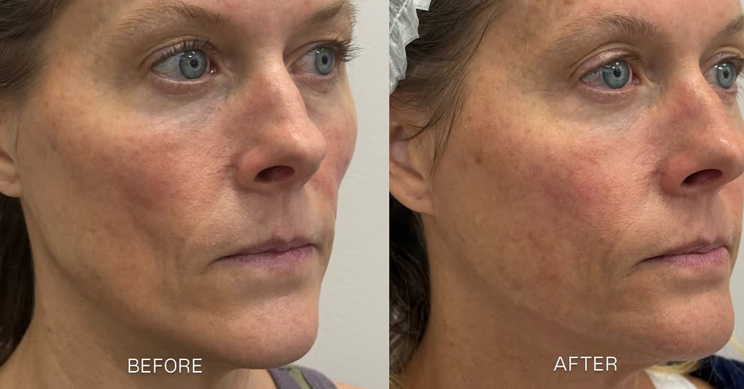 Instagram post by Dr. Gregory F. Bland: December 22, 2025 → August 18, 2026. 8 months of Sculptra results with 3 vials✨ Unlike traditional fillers that add volume immediately, Scul…