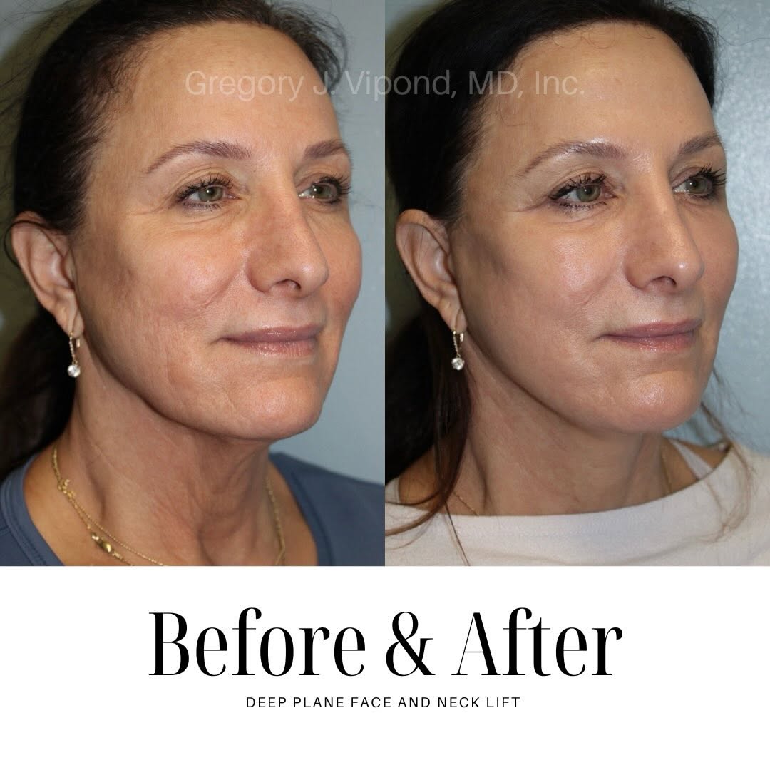 Instagram post by Dr. Gregory J. Vipond: One month post op and she already looks incredible! Some swelling still which is normal, it varies between patients but we are loving her na…