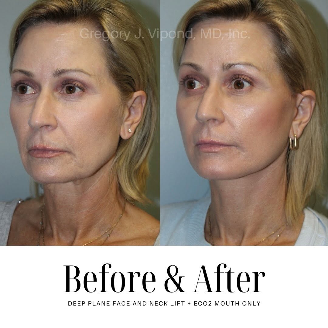 Instagram post by Dr. Gregory J. Vipond: A Deep Plane Face and Neck Lift isn’t about changing your face, it’s about restoring structure, contour and balance. The results show how re…