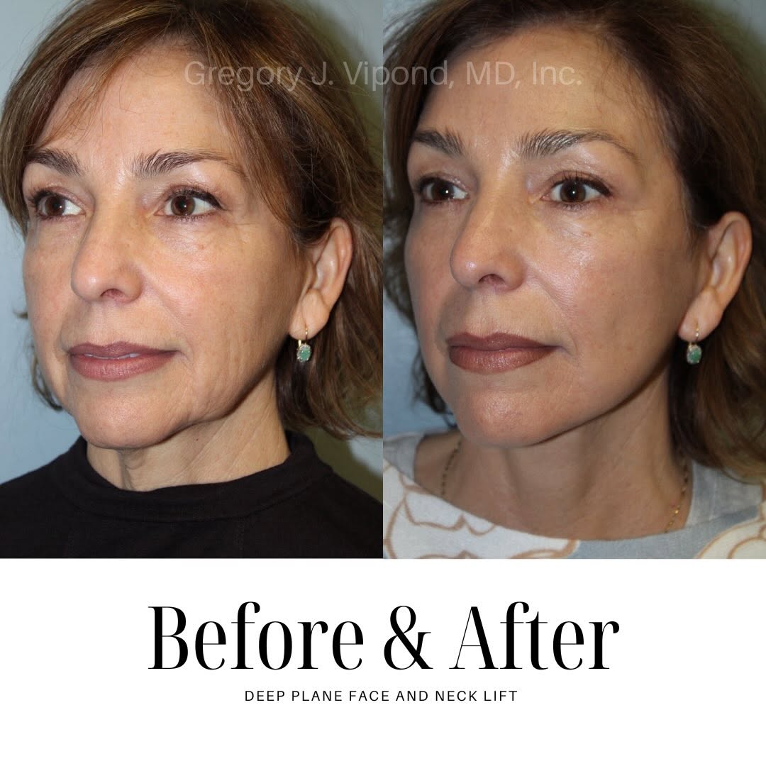 Instagram post by Dr. Gregory J. Vipond: Natural results, never overdone.✨ #deepplanefacelift #facialplasticsurgeon #beforeandafter