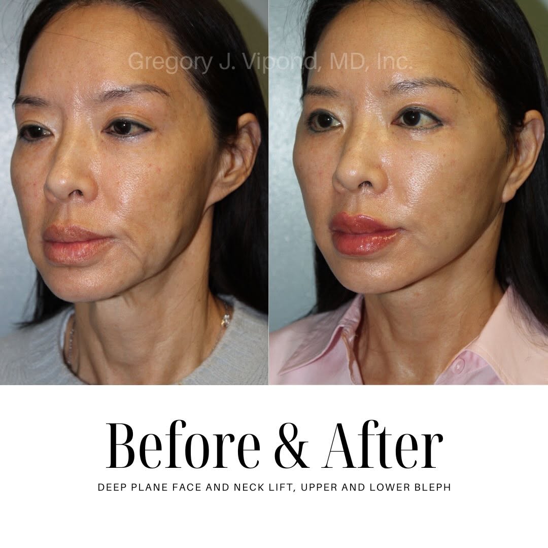 Instagram post by Dr. Gregory J. Vipond: Expertise, precision and artistry in every facial rejuvenation procedure✨✍🏼 #facialplasticsurgeon #beforeandafter #naturalresults