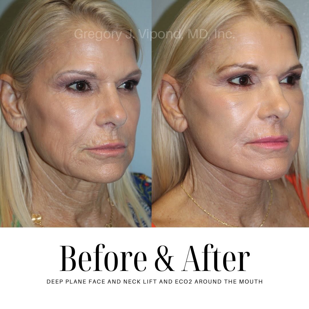 Instagram post by Dr. Gregory J. Vipond: A refreshed natural looking appearance starts beneath the surface. This Deep Plane Face and Neck lift result highlights smoother contours, r…