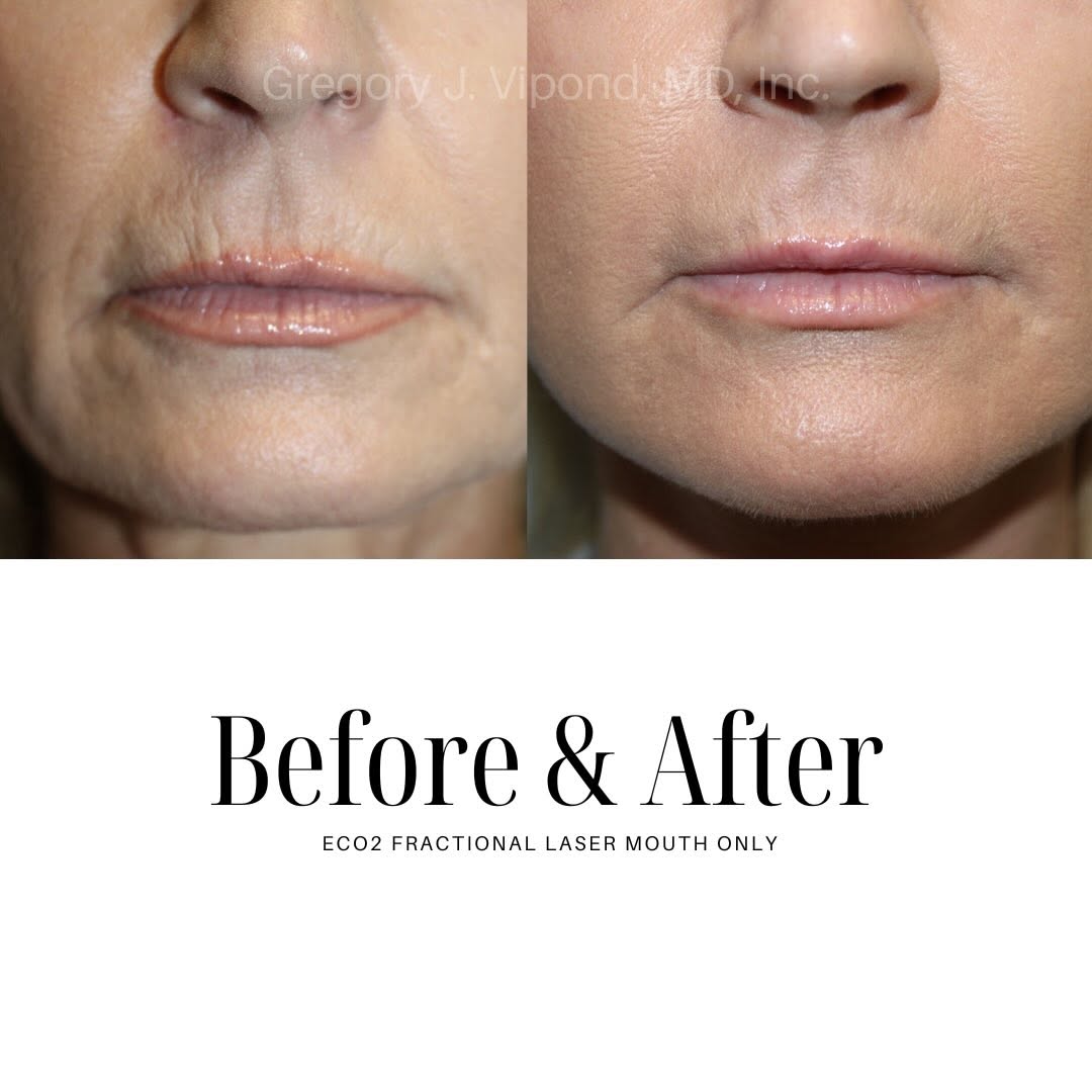 Instagram post by Dr. Gregory J. Vipond: Skin renewal, one session at a time⚡️✨ Eco2 fractional laser helps improve texture, reduce scars, soften fine lines and reveal smoother brig…