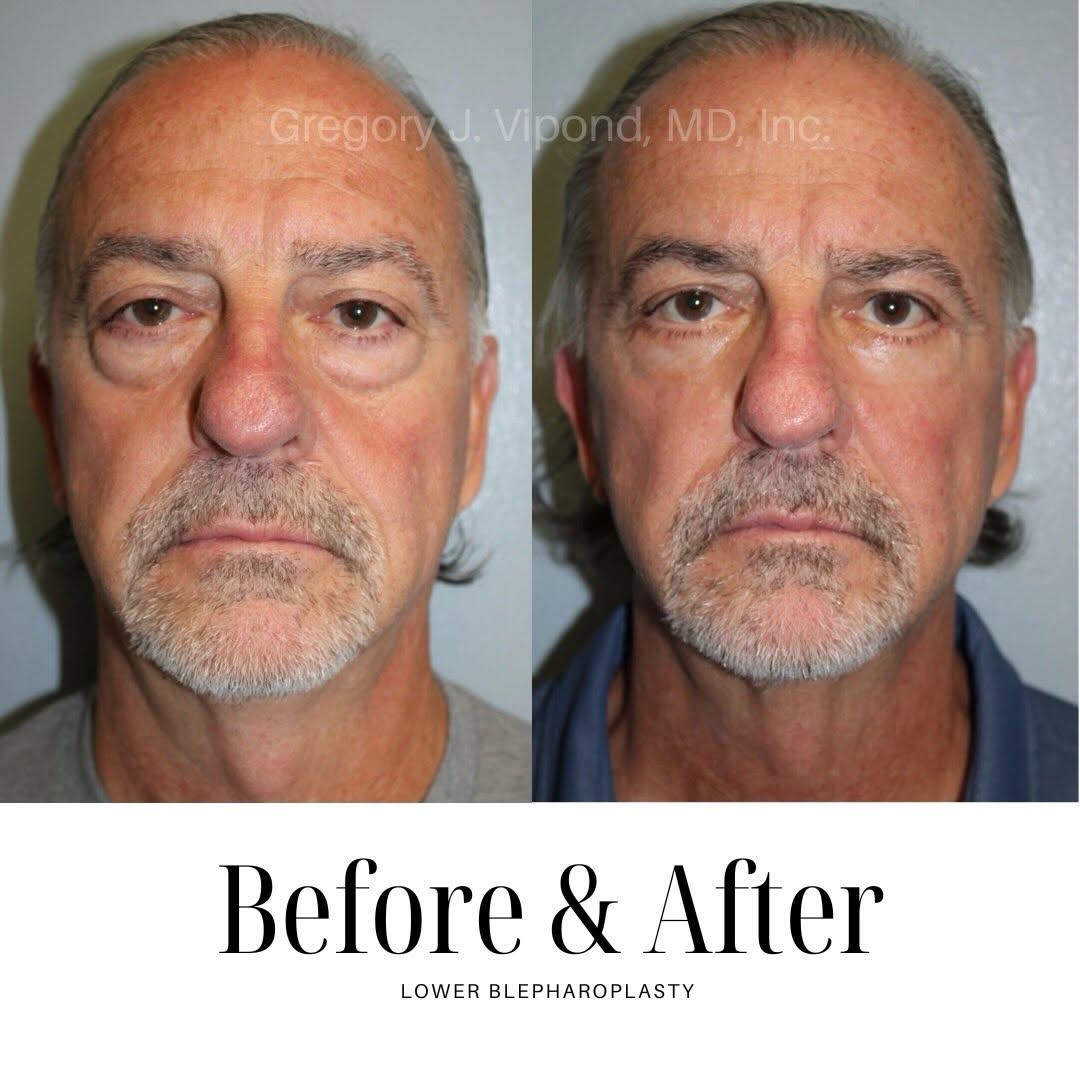 Instagram post by Dr. Gregory J. Vipond: A refreshed look starts with the details. Lower blepharoplasty can address under eye bags and excess skin to create a smoother, more rested …