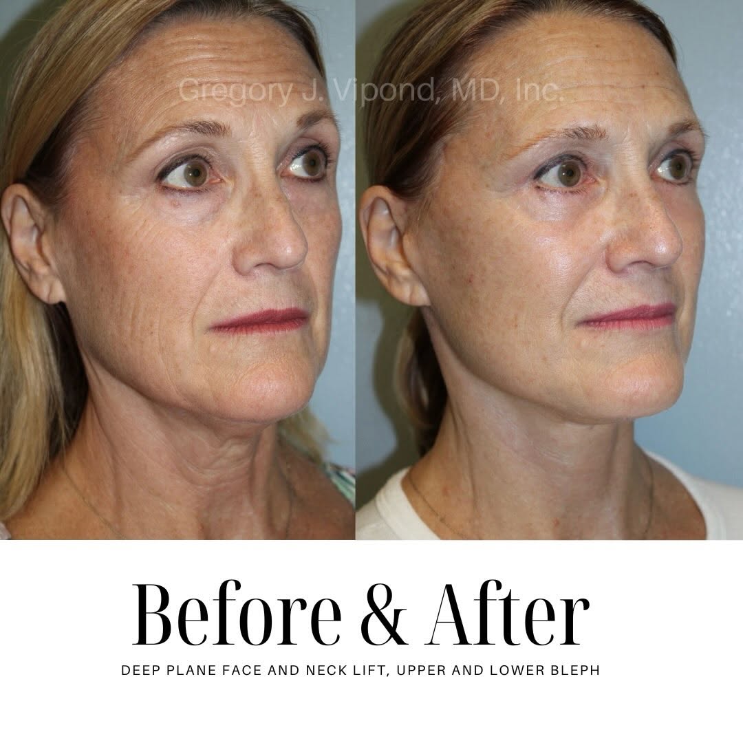 Instagram post by Dr. Gregory J. Vipond: Every transformation tells a story of confidence, balance and personalized care. These before and after results highlight natural looking en…