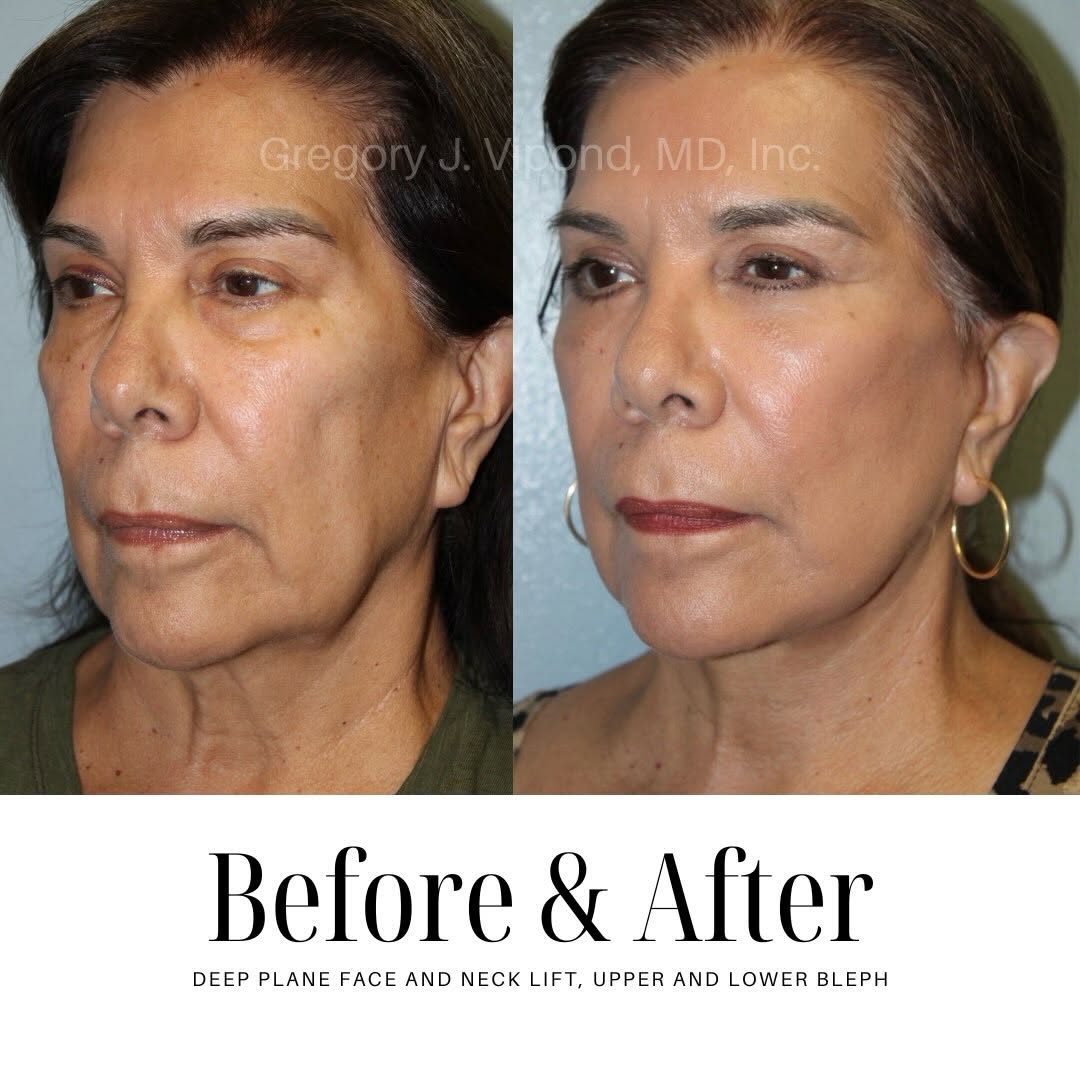 Instagram post by Dr. Gregory J. Vipond: The power of a natural-looking transformation✨ #beforeandafter #facialplasticsurgery #naturalresults