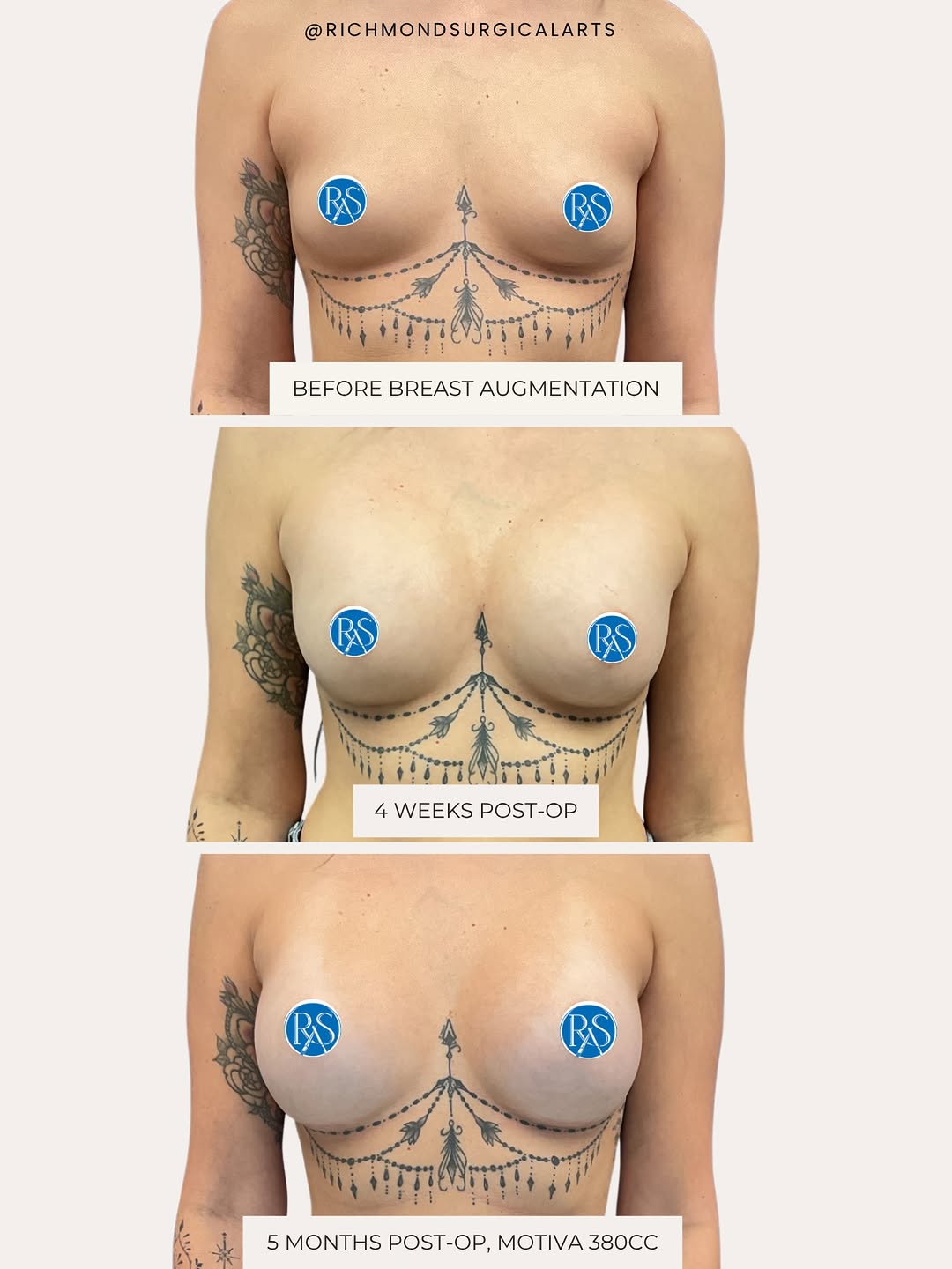 Instagram post by Dr. Gregory T. Lynam: The importance of giving breast implants time to settle. This patient had a breast augmentation with Motiva Ergonomix 380cc silicone implant…