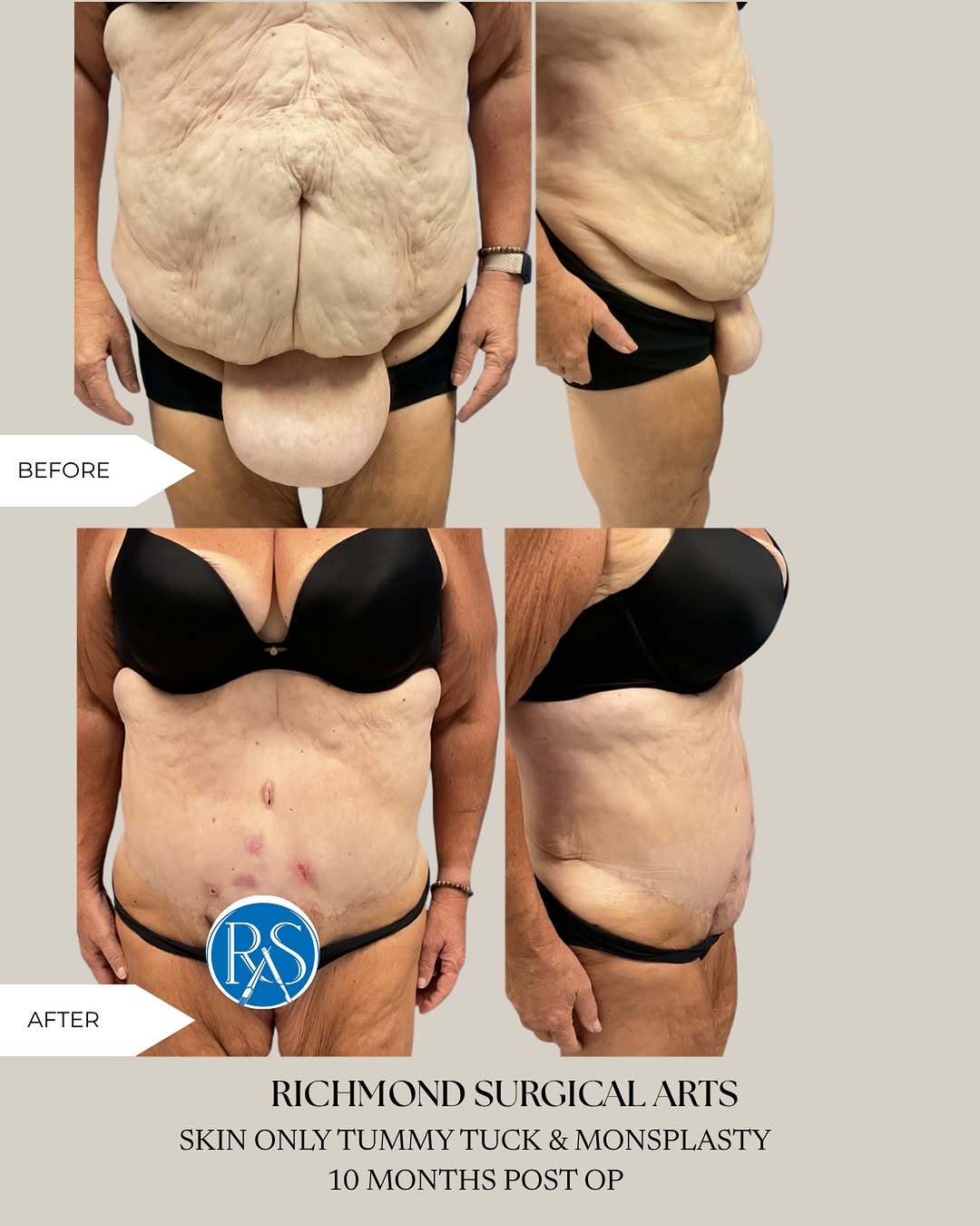 Instagram post by Dr. Gregory T. Lynam: Sometimes, the areas patients are most hesitant to talk about can make the biggest difference. For this patient, the transformation was more…