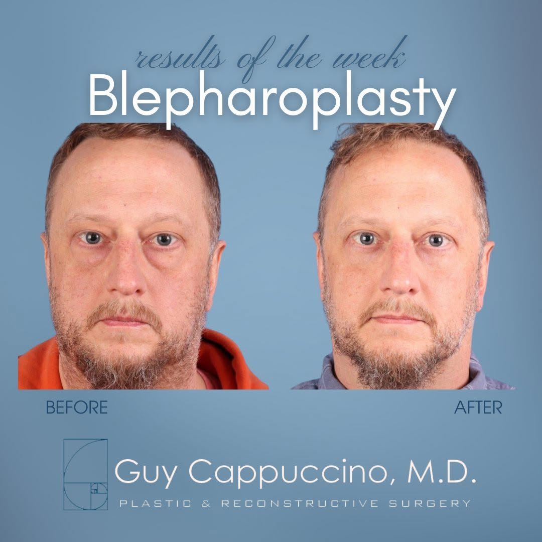 Instagram post by Dr. Guy Cappuccino: Our 51 year old patient looks refreshed 3 months after his Upper and Lower Blepharoplasty with Fat Grafting to the Orbital Hollows. Dr. Guy …